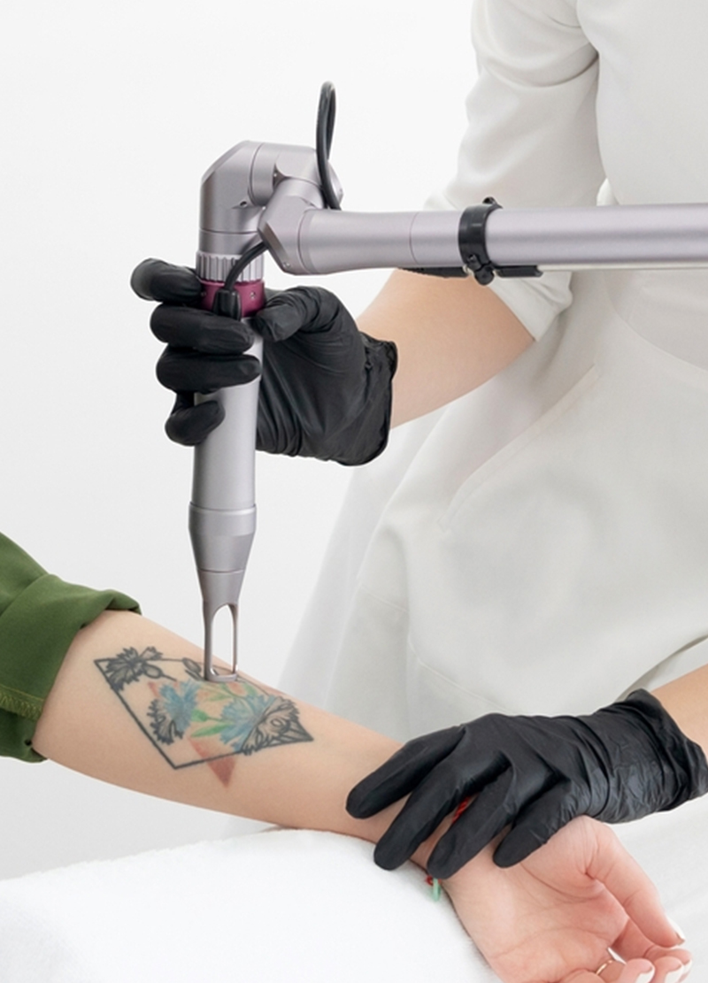 Using Micro Needling To Increase Laser Tattoo Removal Efficiency | deINK Tattoo  Removal